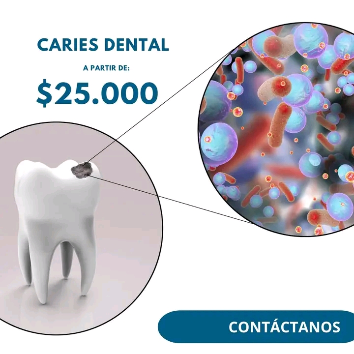 Ilustración de caries dental y bacterias causantes