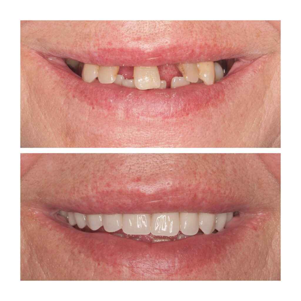 Antes y después dental